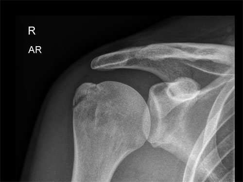 Before : Shoulder fracture 23 March 2010