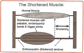 Fig 4. Shortened muscle syndrome (source: www.istop.org/education.html)